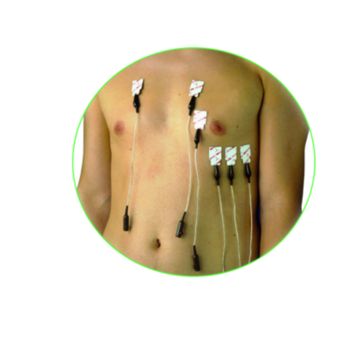 Electrodes 3M 2330 Red Dot - le sachet de 100 PCS