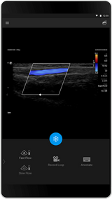 Philips Lumify échographe portable connecté